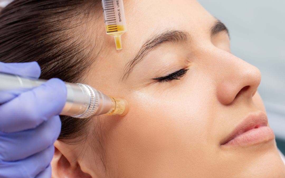 Microneedling & PRP Facial